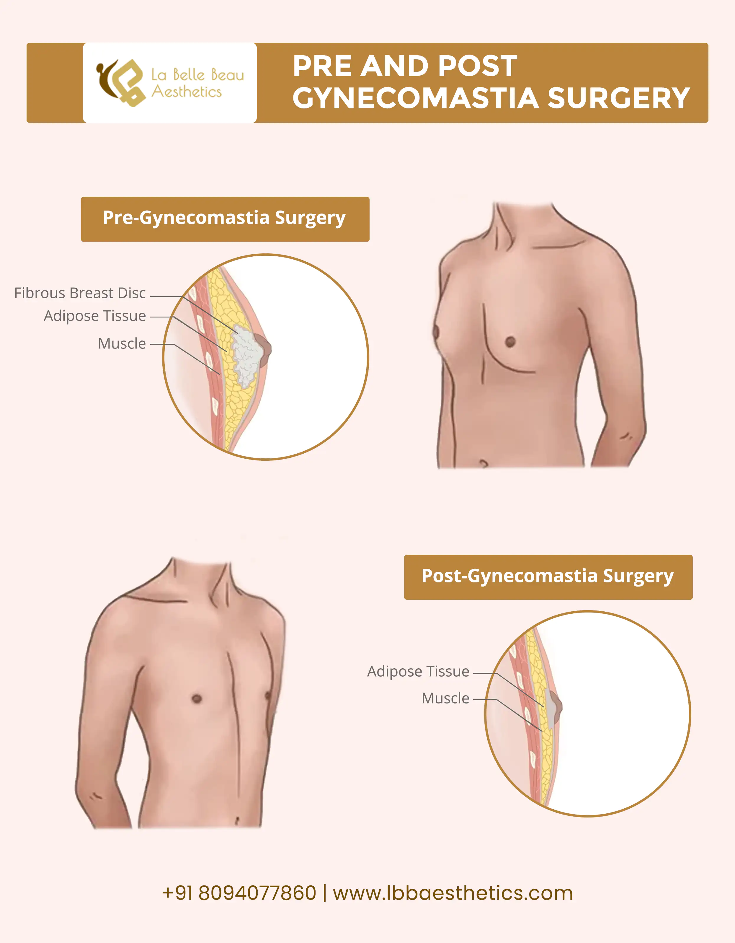 Gynecomastia Things Consider Opting Gynaecomastia Surgery