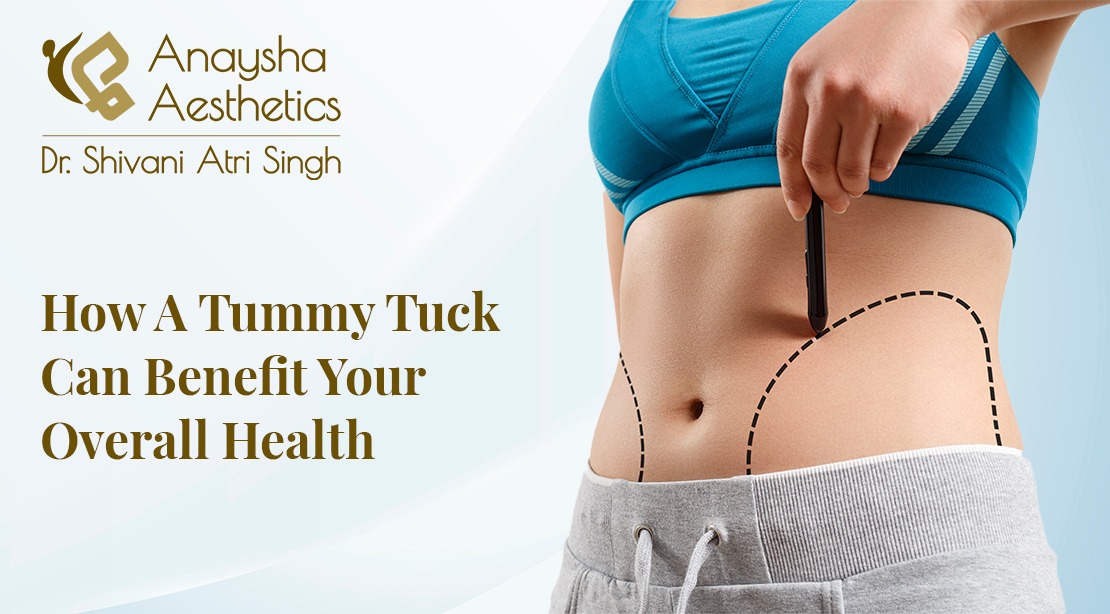 How a Tummy Tuck Can Benefit Your Overall Health
